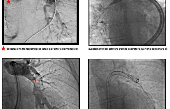 Cardiologia: primo intervento di trombo-aspirazione polmonare in provincia di Trapani
