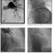 Cardiologia: primo intervento di trombo-aspirazione polmonare in provincia di Trapani